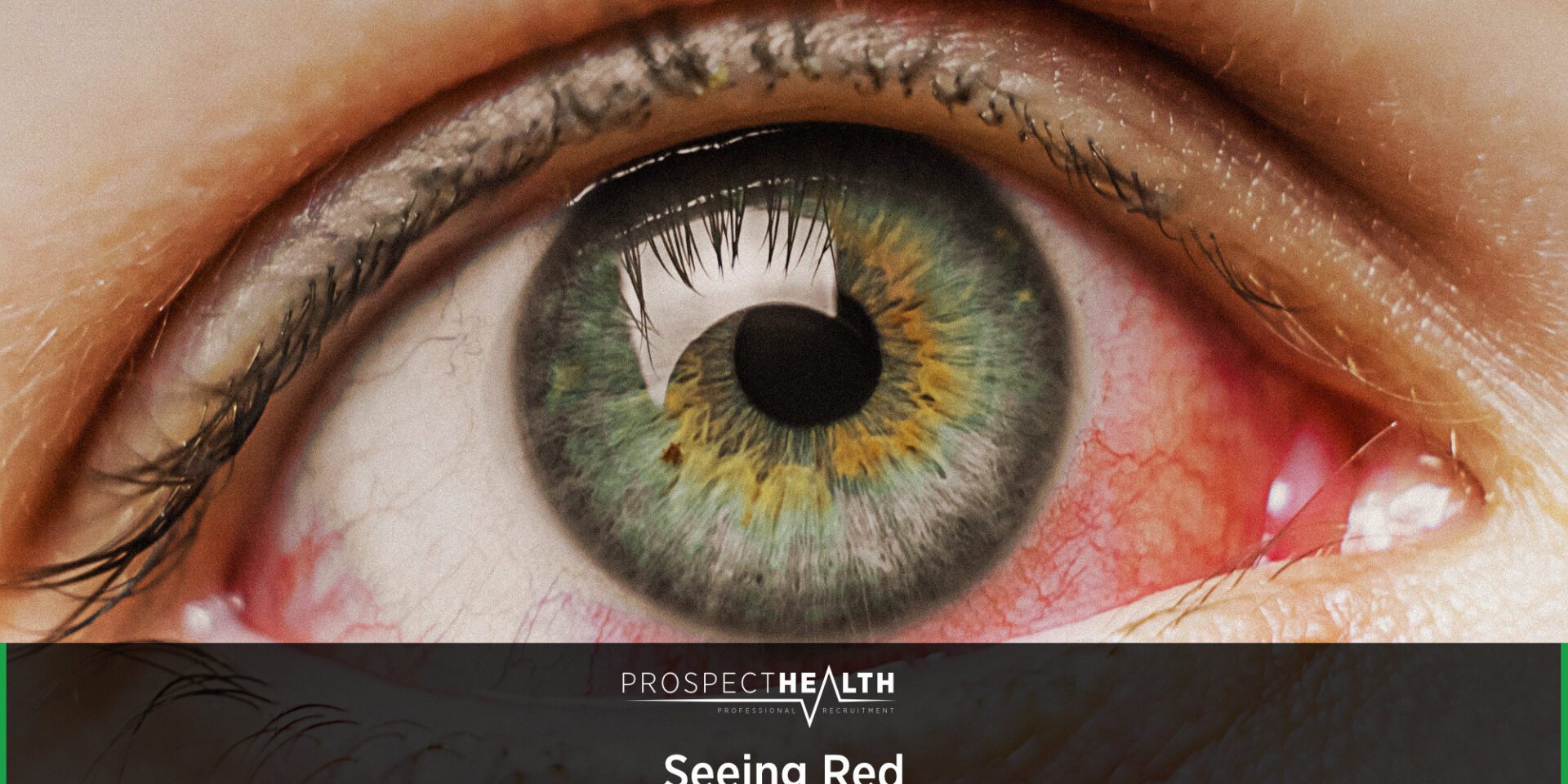 Seeing Red: A Practical Guide to Red Eye for Optometrists in Pre-Reg Preparation