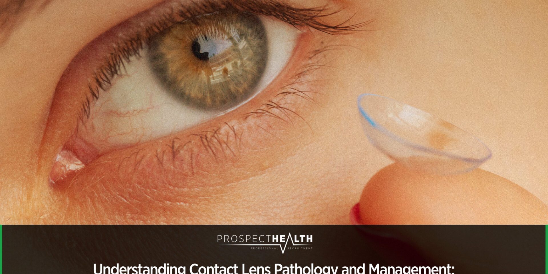 Understanding Contact Lens Pathology and Management: A Deep Dive for Optometry Students