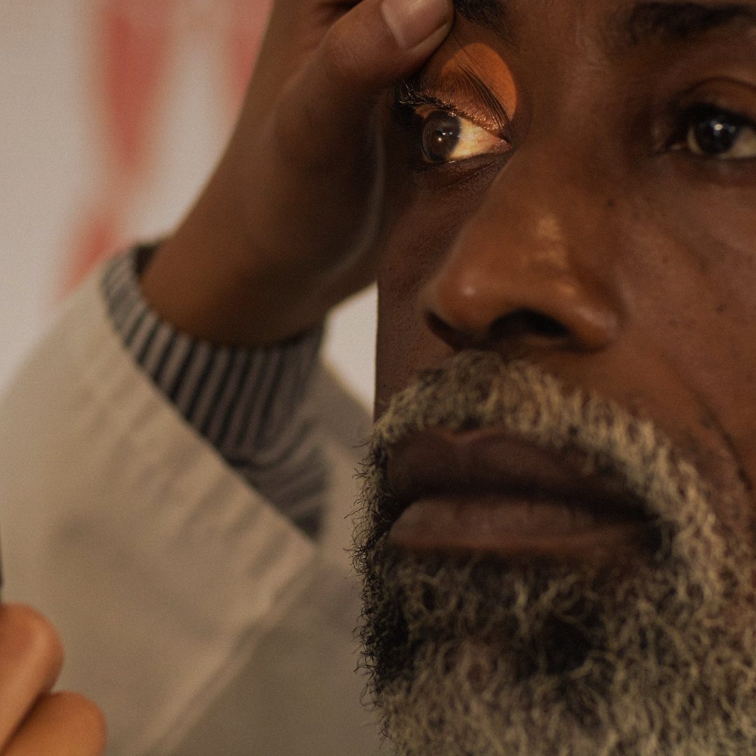 Understanding Glaucoma: Key Insights for Optometry Students and Pre-Reg Optometrists